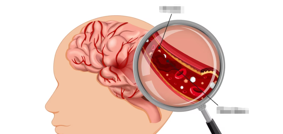 脑出血昏迷能醒吗