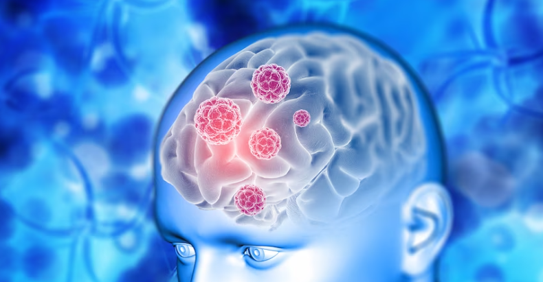 what intracranial diseases can cause coma? 有哪些颅内疾病会引起昏迷