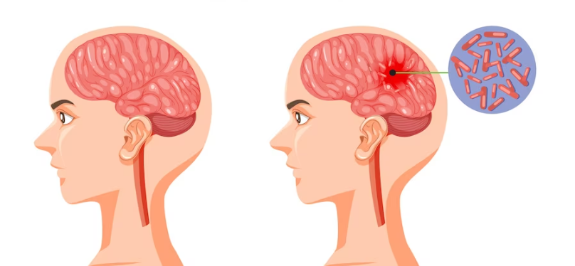 脑不同部位引起昏迷的原因分析