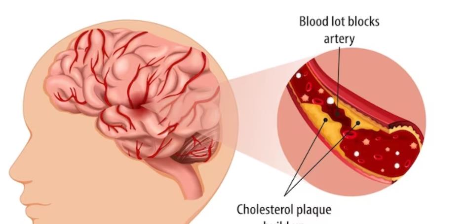 脑溢血昏迷发烧怎么治？