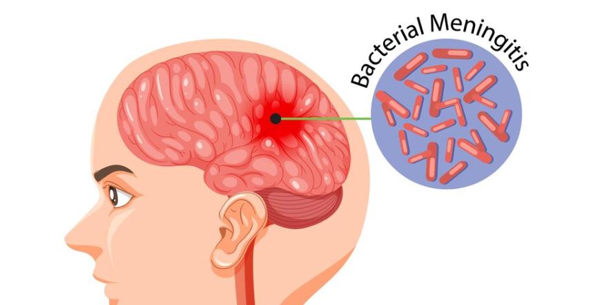 how long does it take for a patient with cerebral hemorrhage to breathe on his own? 脑出血患者多久能自主呼吸