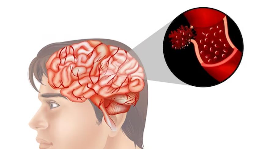 a brief discussion on the mortality rate of hypertensive cerebral hemorrhage